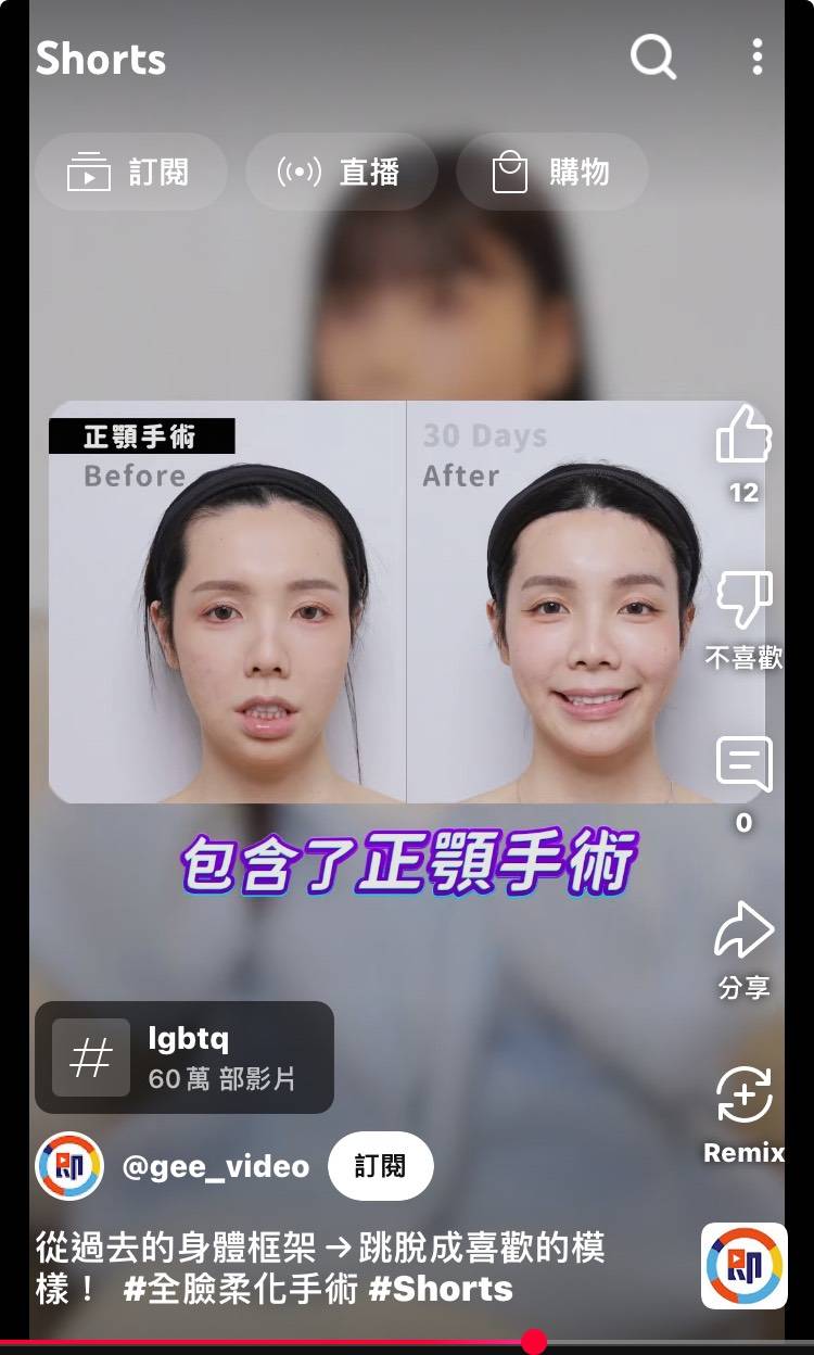 [討論] 面部問題真的應該也考慮一下正顎手術