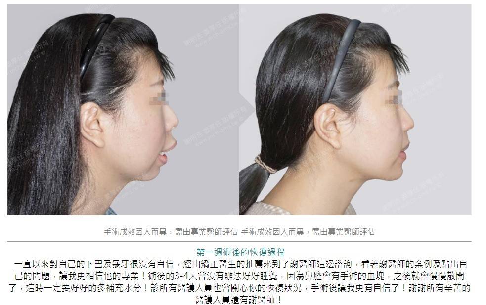 [問題] 骨性暴牙正顎 風華/凡登/麗舍推薦哪一家?